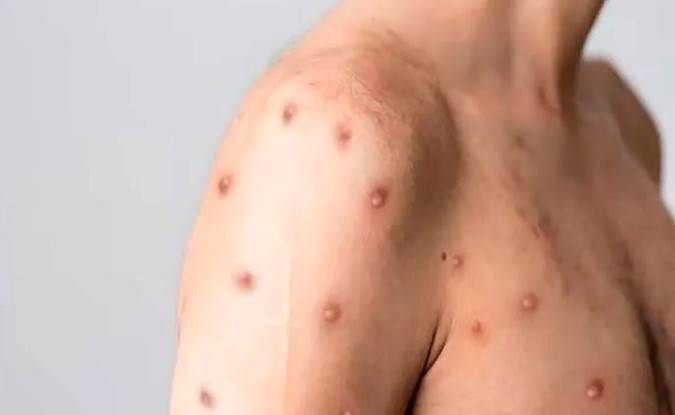 Alerta sanitaria: paciente alemán trae viruela símica a México